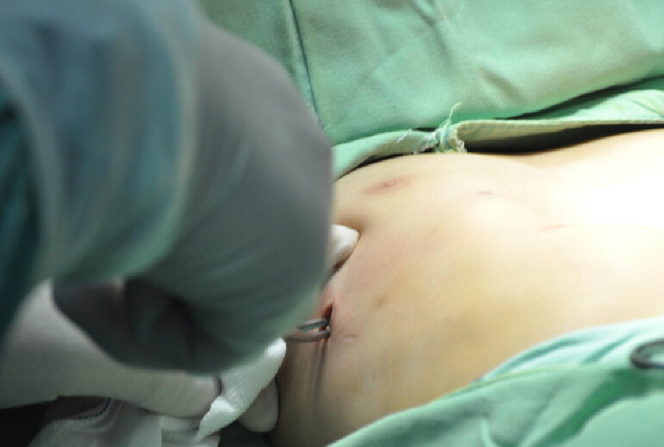 第四步：手术正式开始，先在右胸开一个1-2cm的小孔。